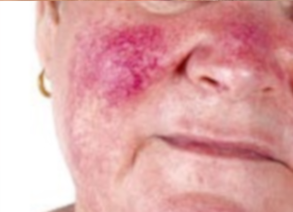 Mittel gegen rosacea